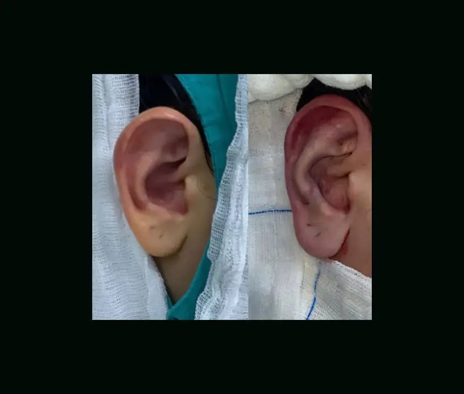 tugce-simsek-md-ear-surgery-before-after-3-1
