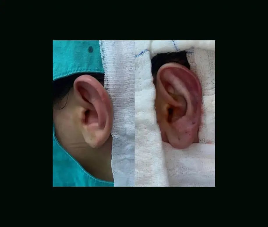 tugce-simsek-md-ear-surgery-before-after-4-1