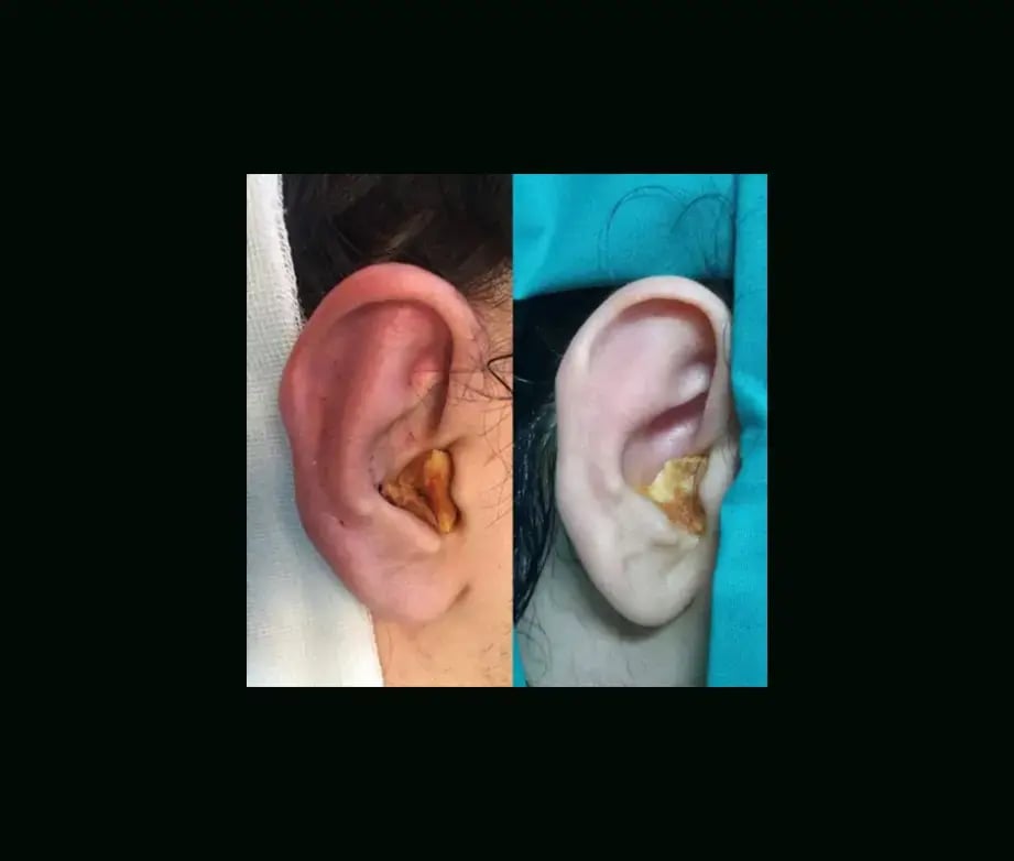 tugce-simsek-md-ear-surgery-before-after-5