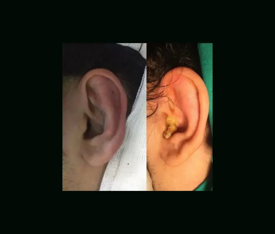 tugce-simsek-md-ear-surgery-before-after-6