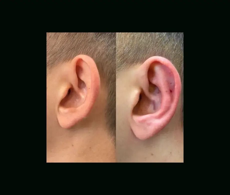 tugce-simsek-md-ear-surgery-before-after-7-1