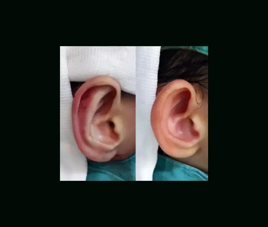 tugce-simsek-md-ear-surgery-before-after-8