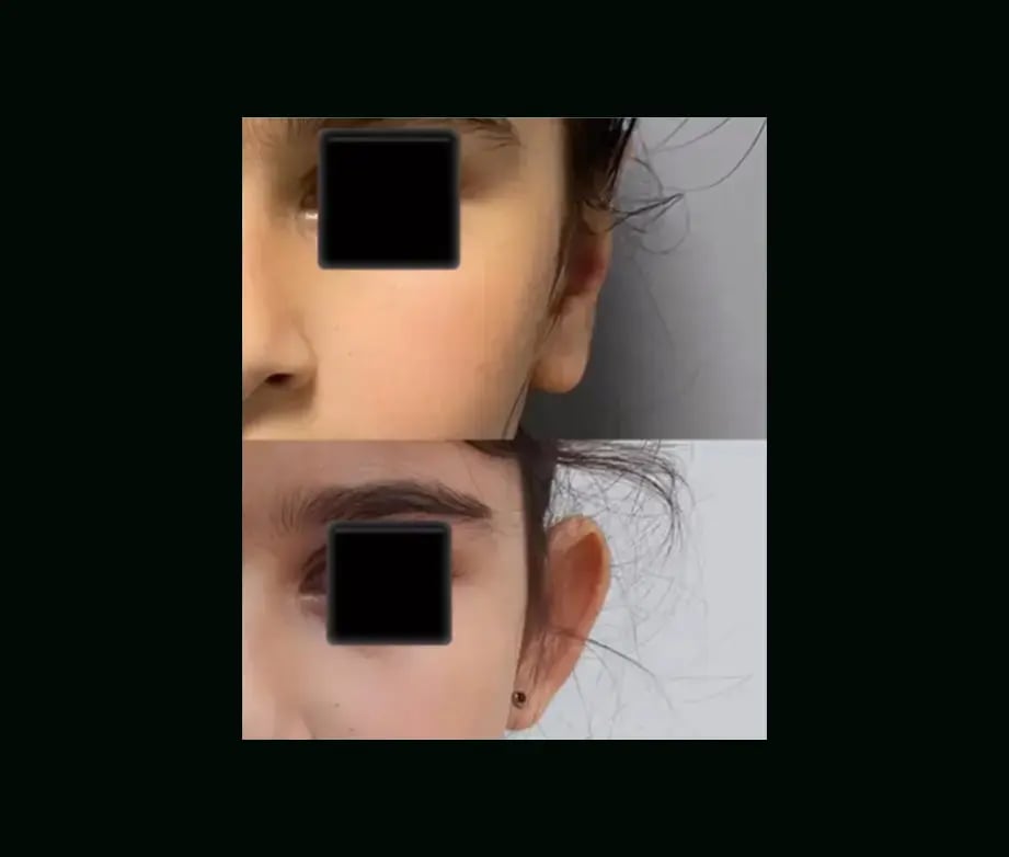 tugce-simsek-md-ear-surgery-before-after-9