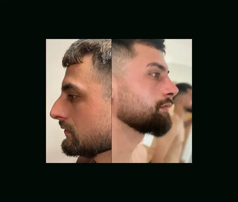 tugce-simsek-md-rhinoplasty-before-after-1-2