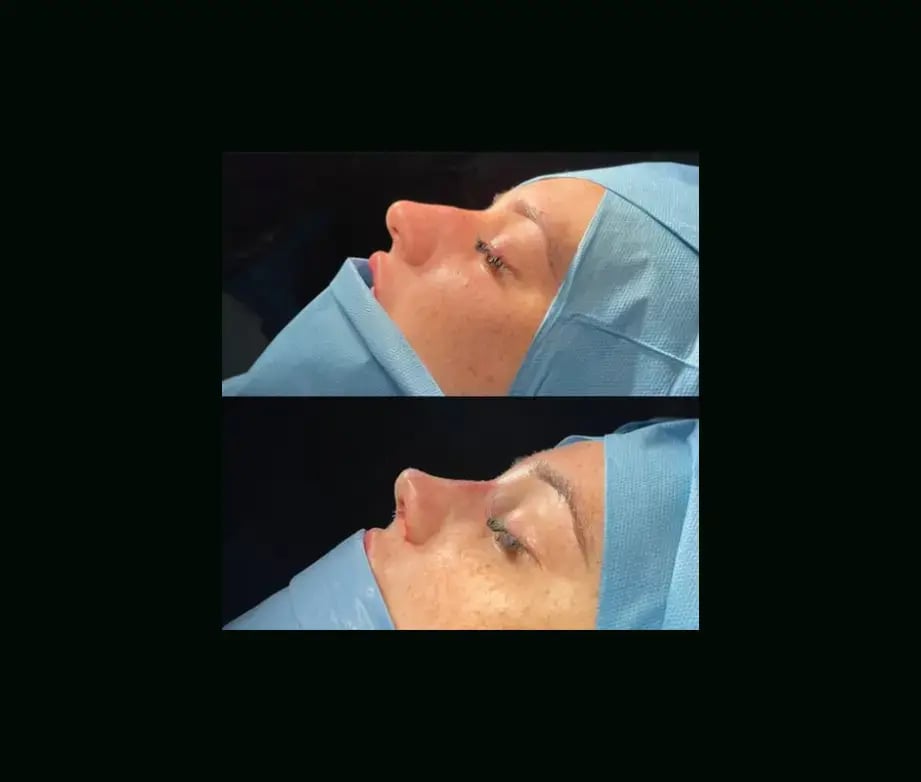 tugce-simsek-md-rhinoplasty-before-after-10