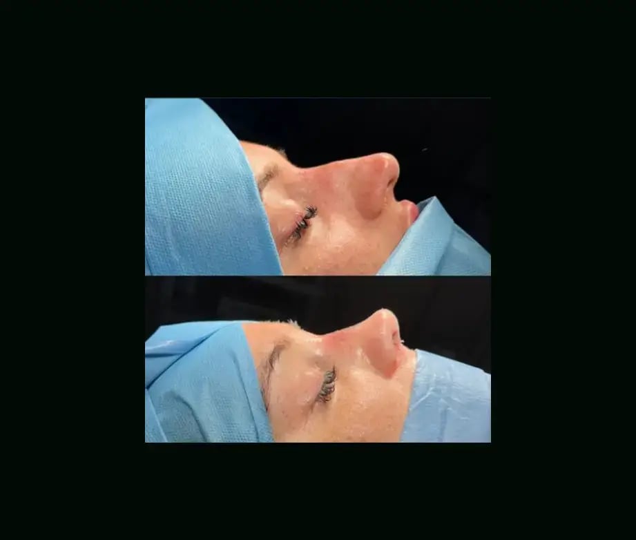 tugce-simsek-md-rhinoplasty-before-after-11
