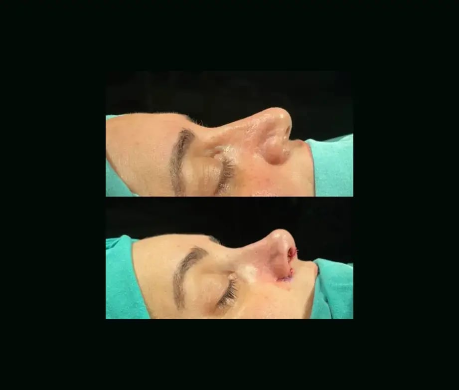 tugce-simsek-md-rhinoplasty-before-after-12