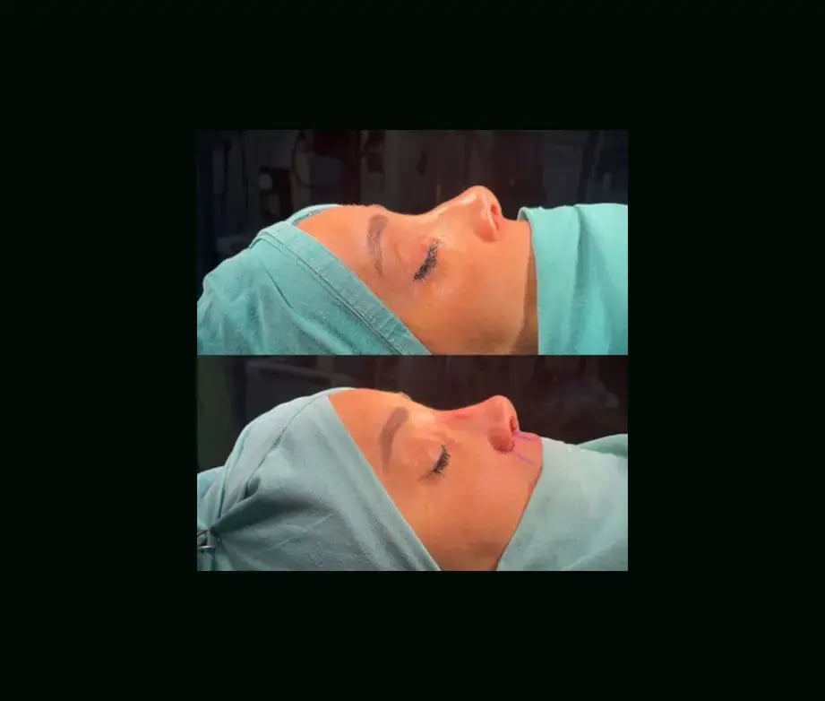 tugce-simsek-md-rhinoplasty-before-after-13