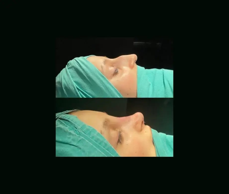 tugce-simsek-md-rhinoplasty-before-after-14