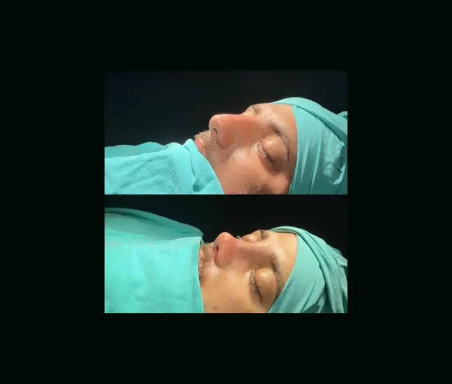 tugce-simsek-md-rhinoplasty-before-after-16