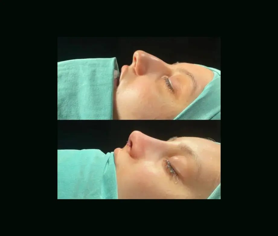tugce-simsek-md-rhinoplasty-before-after-17