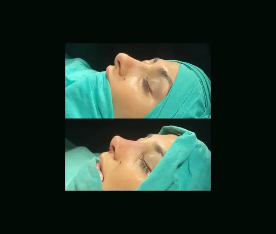 tugce-simsek-md-rhinoplasty-before-after-18-1
