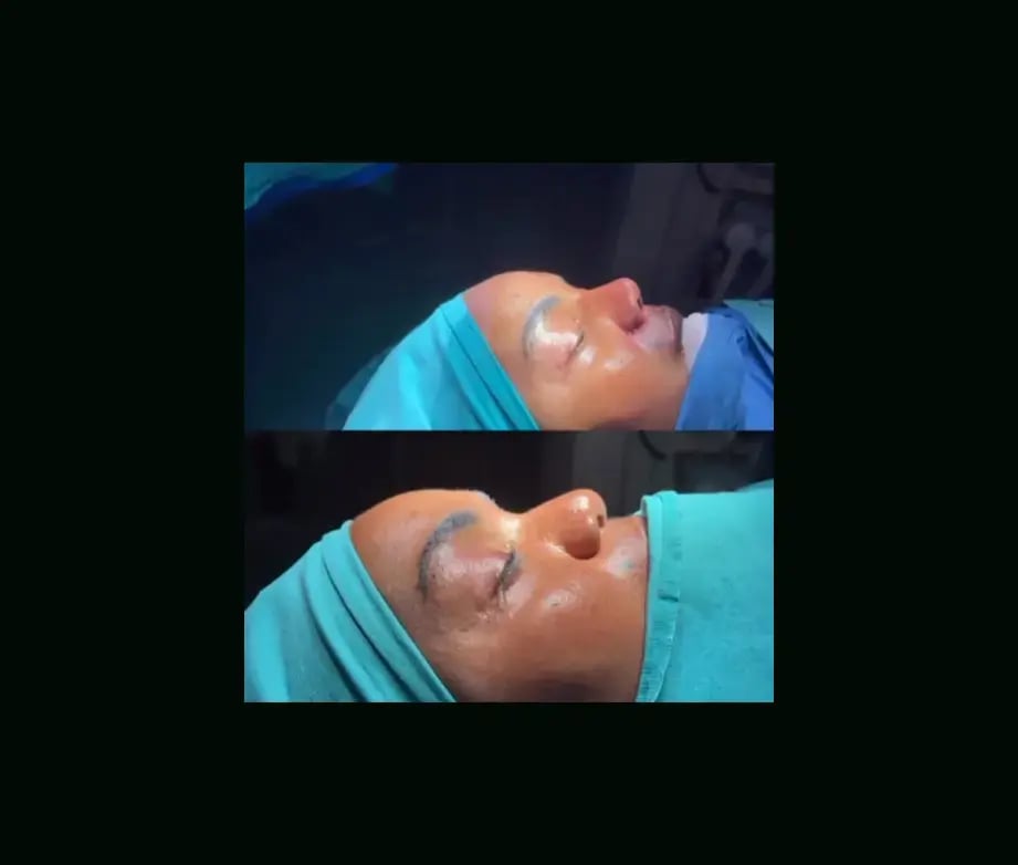 tugce-simsek-md-rhinoplasty-before-after-19-1