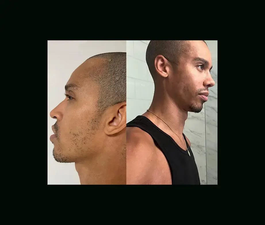 tugce-simsek-md-rhinoplasty-before-after-2-2