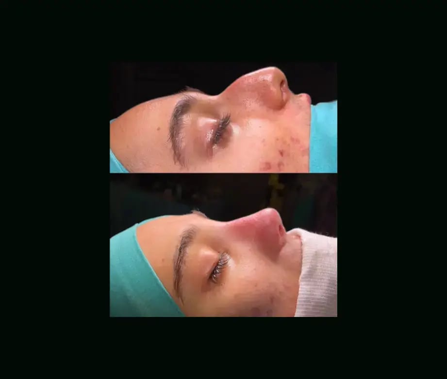 tugce-simsek-md-rhinoplasty-before-after-20-1