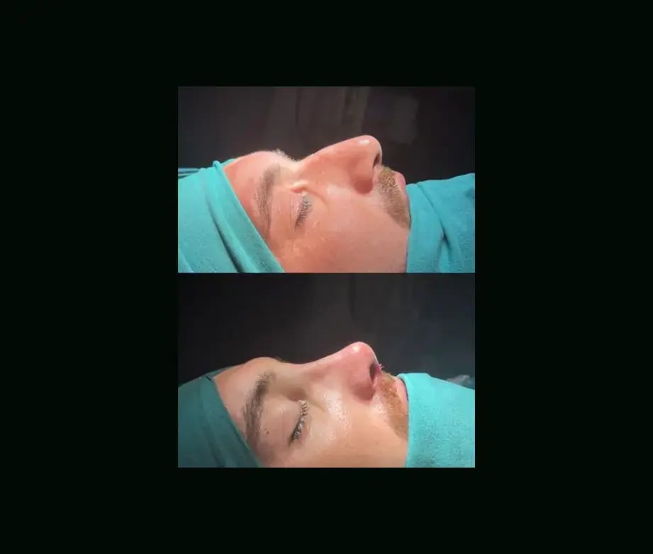 tugce-simsek-md-rhinoplasty-before-after-21
