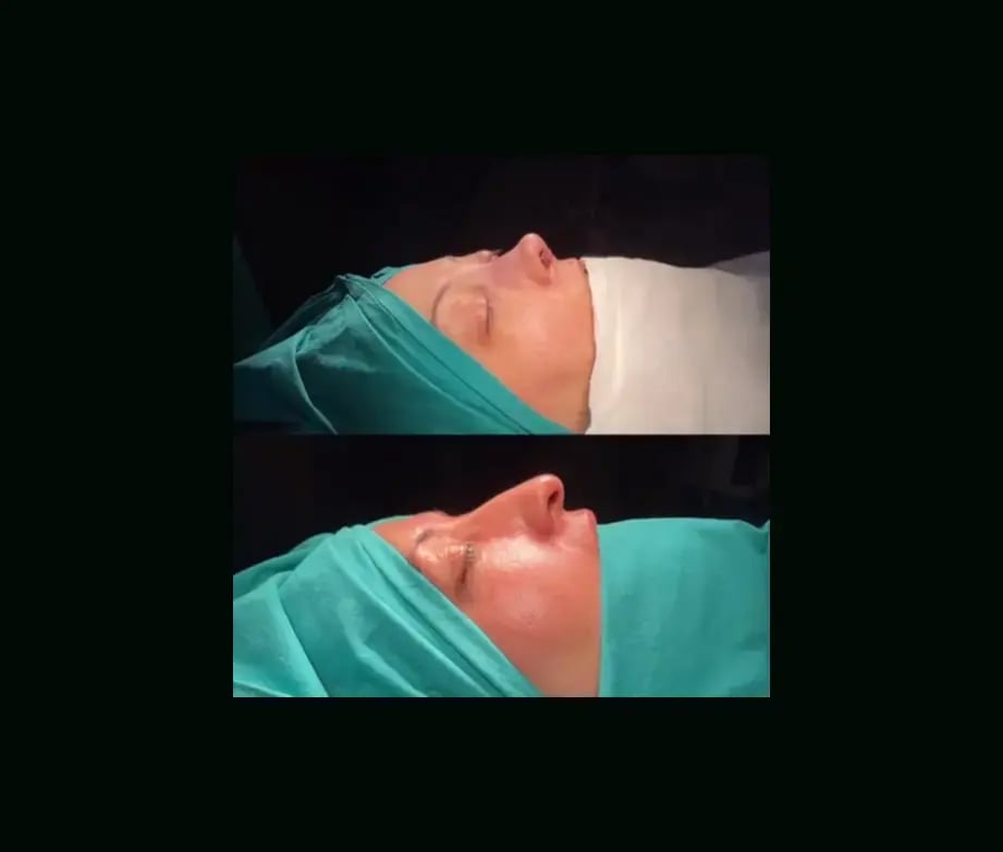 tugce-simsek-md-rhinoplasty-before-after-22