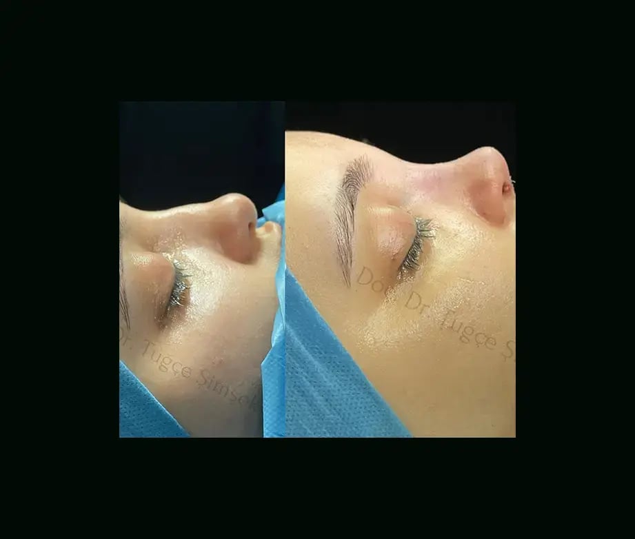tugce-simsek-md-rhinoplasty-before-after-3-1