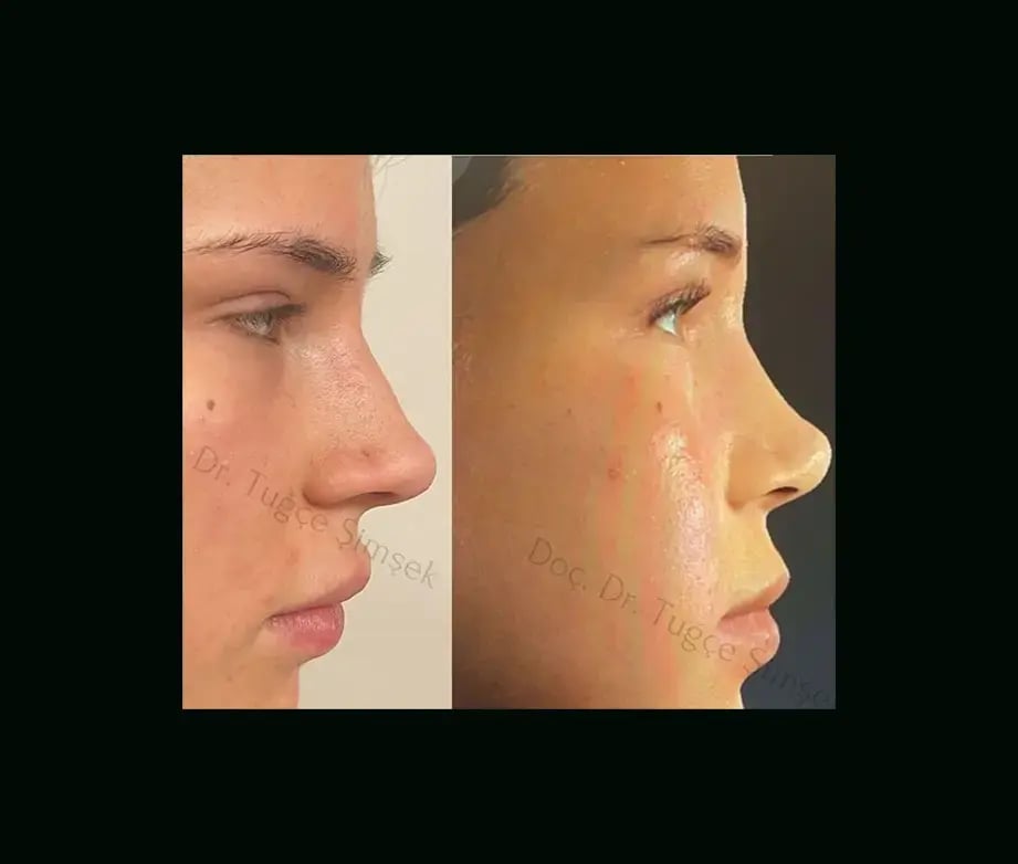 tugce-simsek-md-rhinoplasty-before-after-4-2