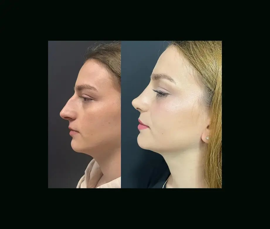 tugce-simsek-md-rhinoplasty-before-after-5-2