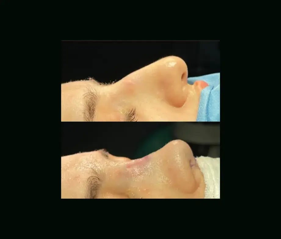 tugce-simsek-md-rhinoplasty-before-after-6