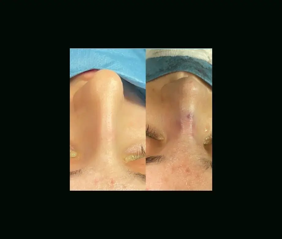 tugce-simsek-md-rhinoplasty-before-after-7