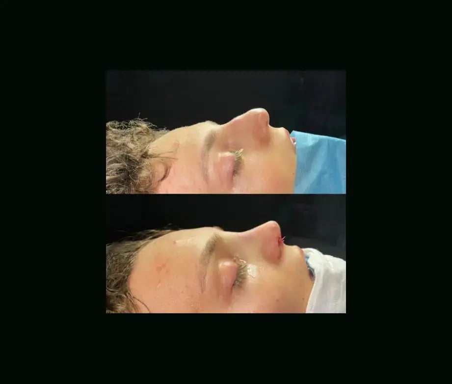 tugce-simsek-md-rhinoplasty-before-after-8-1