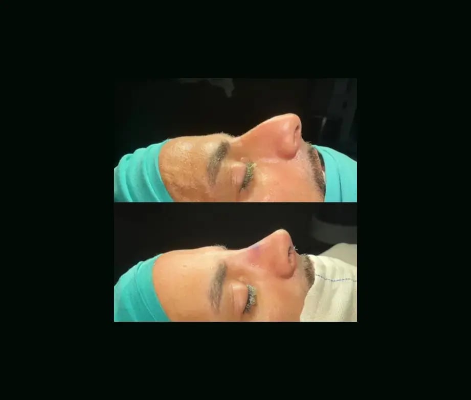 tugce-simsek-md-rhinoplasty-before-after-9