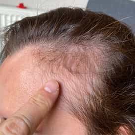 hair transplant- before picture