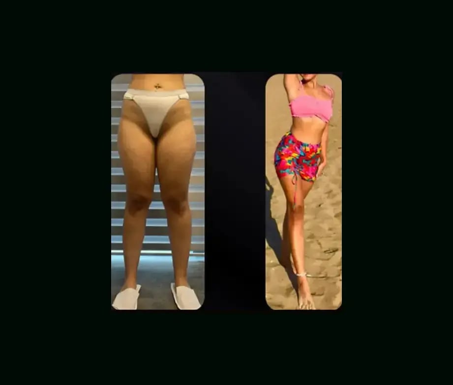 yener-demirtas-md-lipedema-before-after-1-1