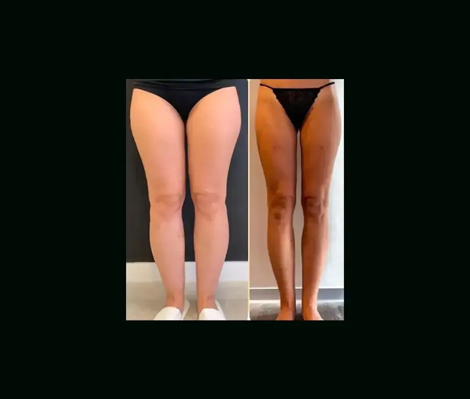 yener-demirtas-md-lipedema-before-after-11-1