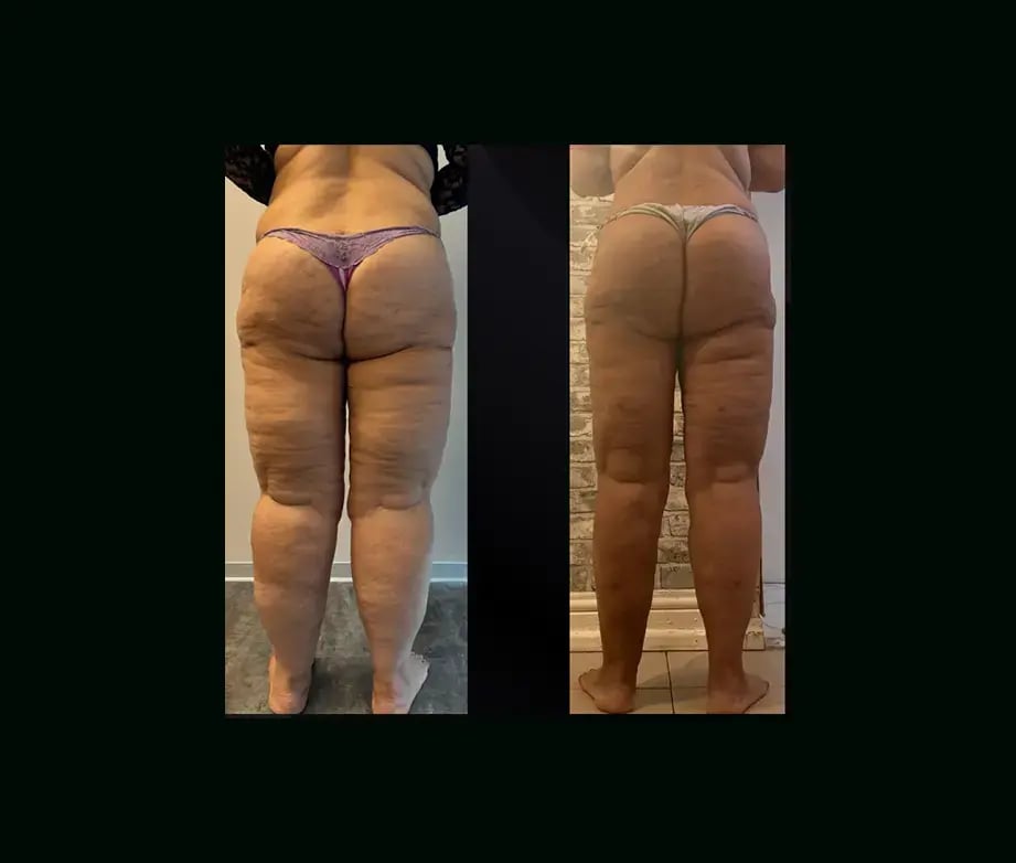 yener-demirtas-md-lipedema-before-after-13-1