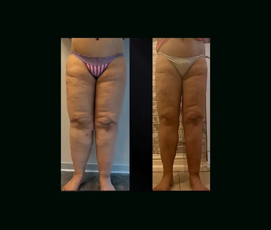 yener-demirtas-md-lipedema-before-after-14