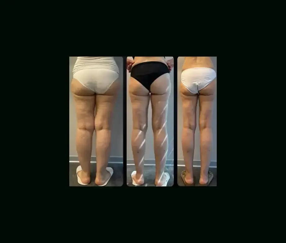 yener-demirtas-md-lipedema-before-after-2-1