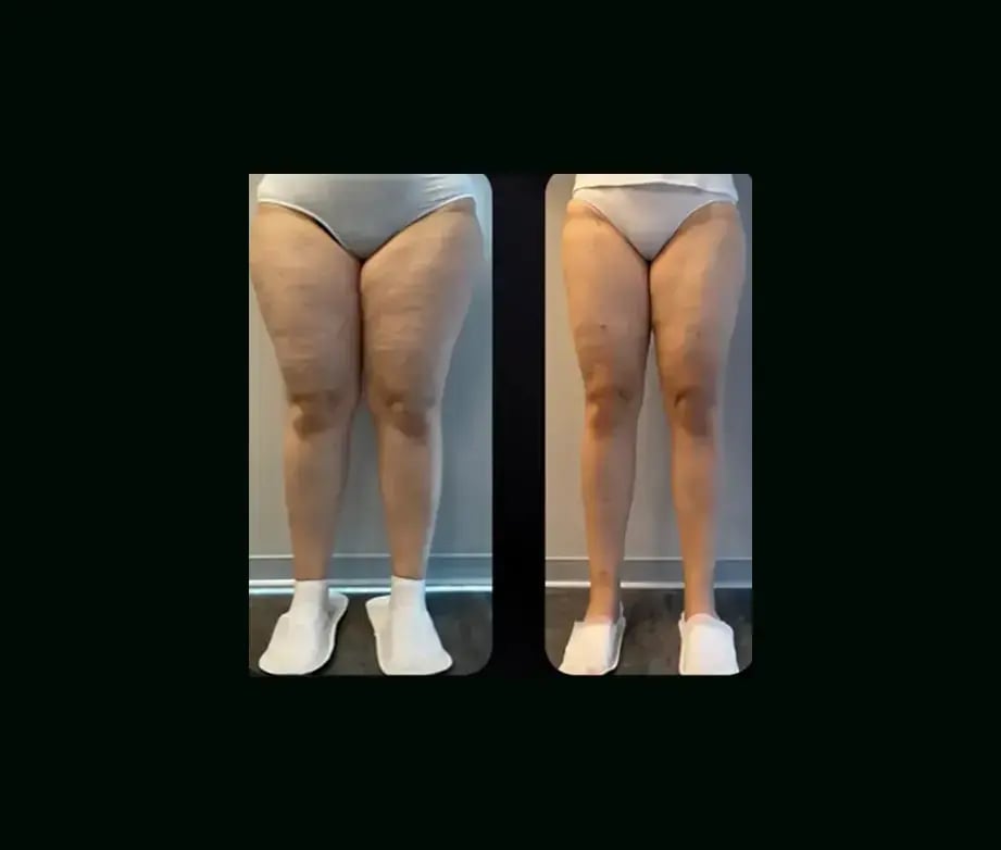 yener-demirtas-md-lipedema-before-after-3-1