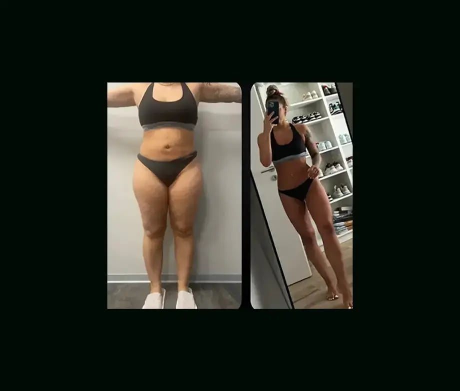 yener-demirtas-md-lipedema-before-after-4-1