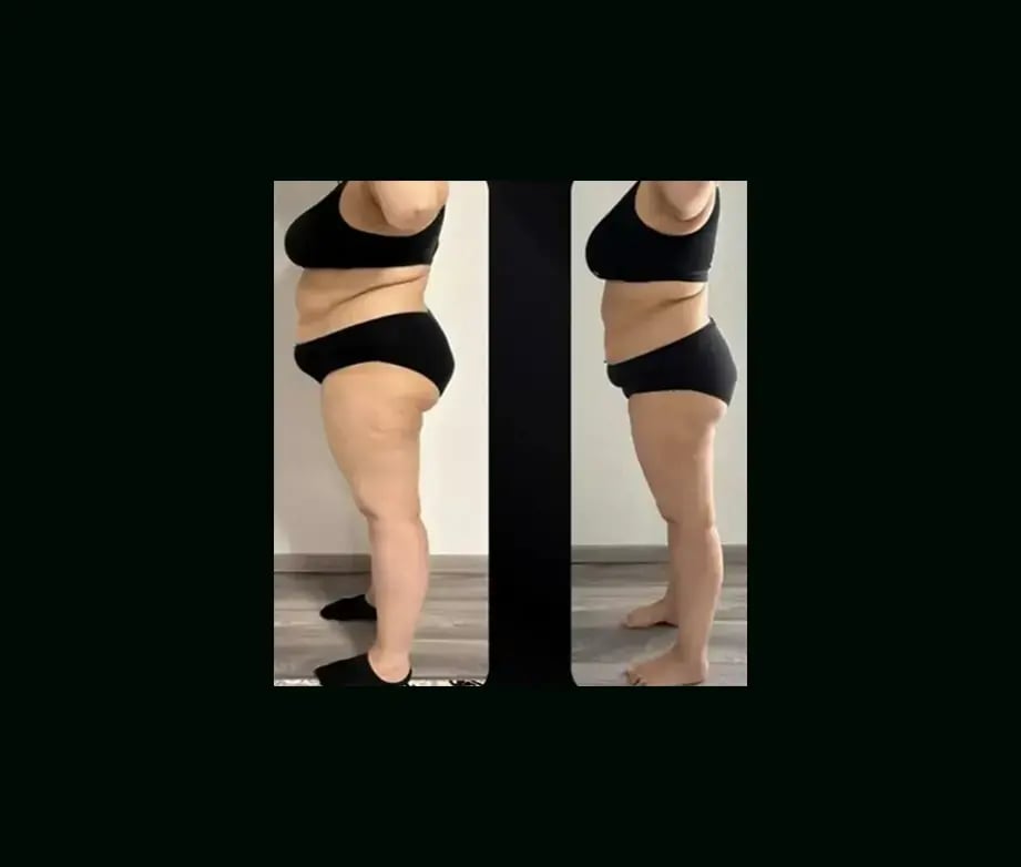 yener-demirtas-md-lipedema-before-after-6-1