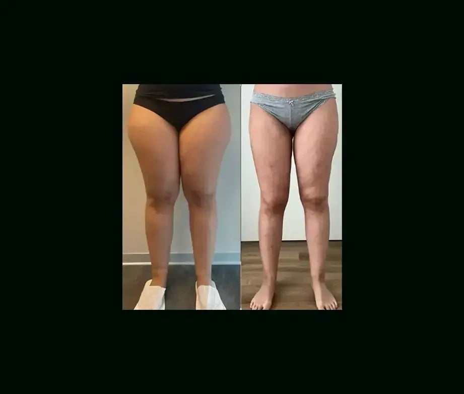 yener-demirtas-md-lipedema-before-after-9-1